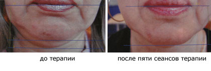 Коррекция второго подбородка